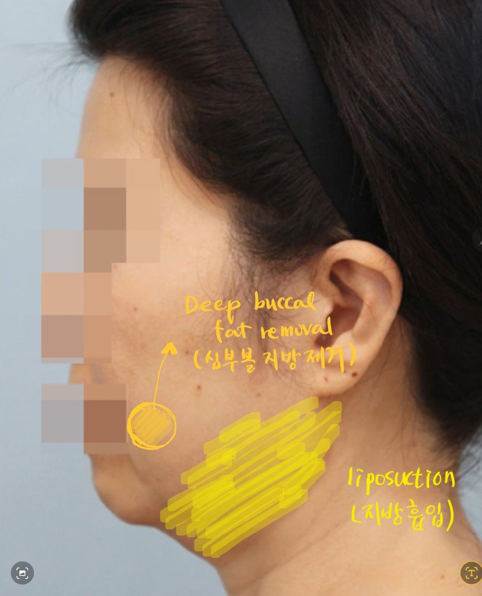 Dissection Range in Facelift Surgery image 4