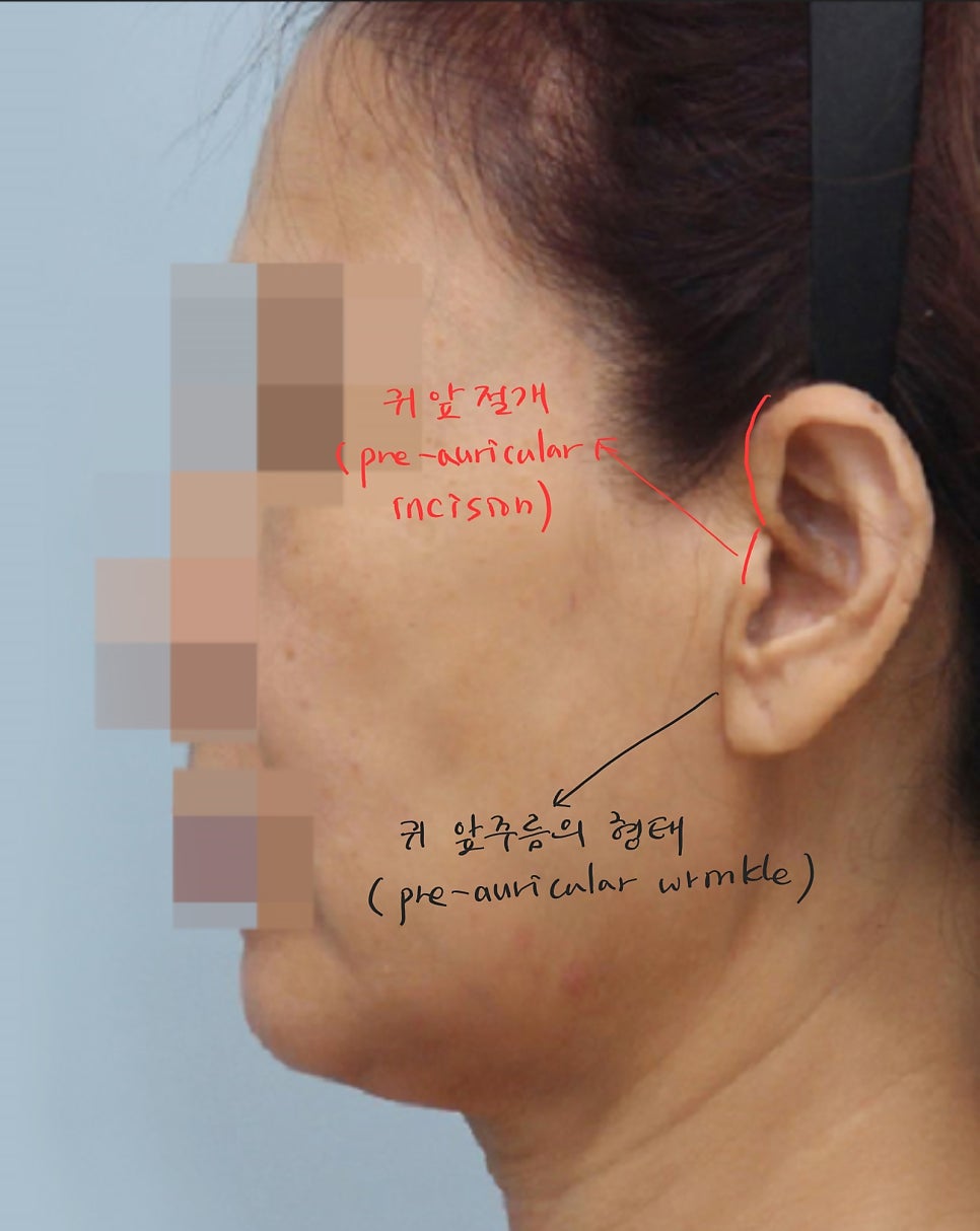 안면거상에서 절개선의 선택방법 관련 이미지 5