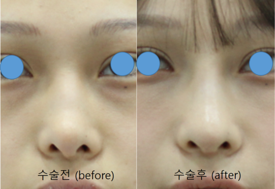 Rib Cartilage Rhinoplasty for a Deviated Saddle Nose image 11