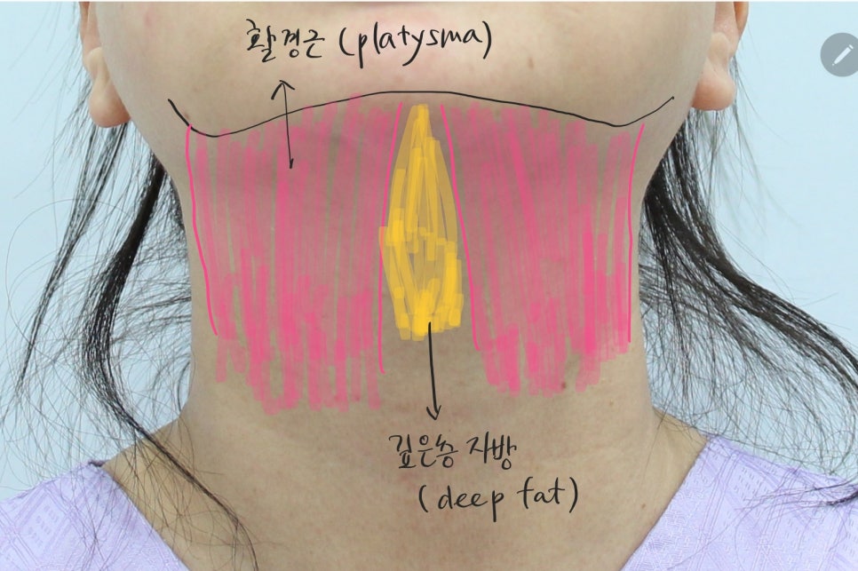 Submental Incision Neck Lift Performed Together with Facelift image 4