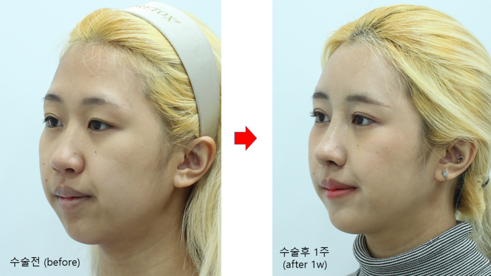 첫번째 코성형, 첫코성형, 20대 코성형 관련 이미지 10