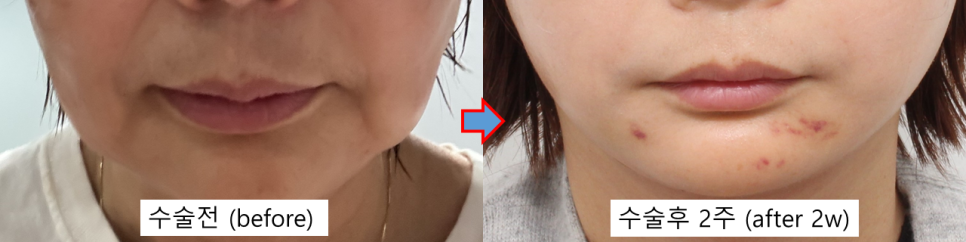 입가 주름 리프팅, 마리오네트 라인 개선하는 방법 관련 이미지 4
