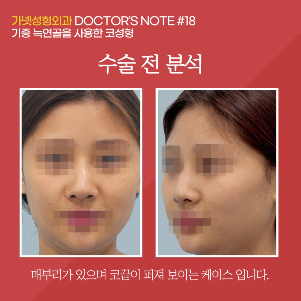 [Garnet Plastic Surgery Director Baek In-soo's Plastic Surgery Column] Rhinoplasty Using Donated Rib Cartilage image 3