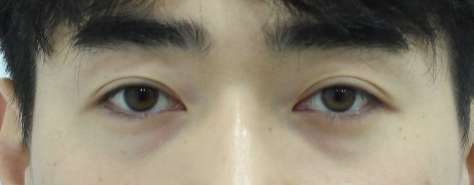 Types of Under-Eye Hollowness and Correction Methods image 2