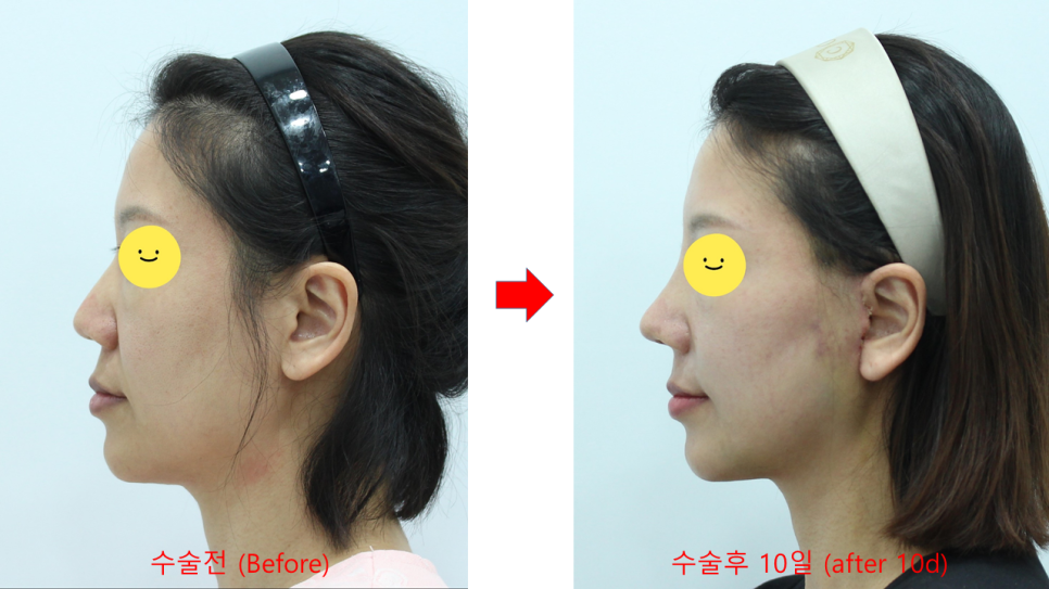 Recovery Period for Midlife Nose Surgery image 5
