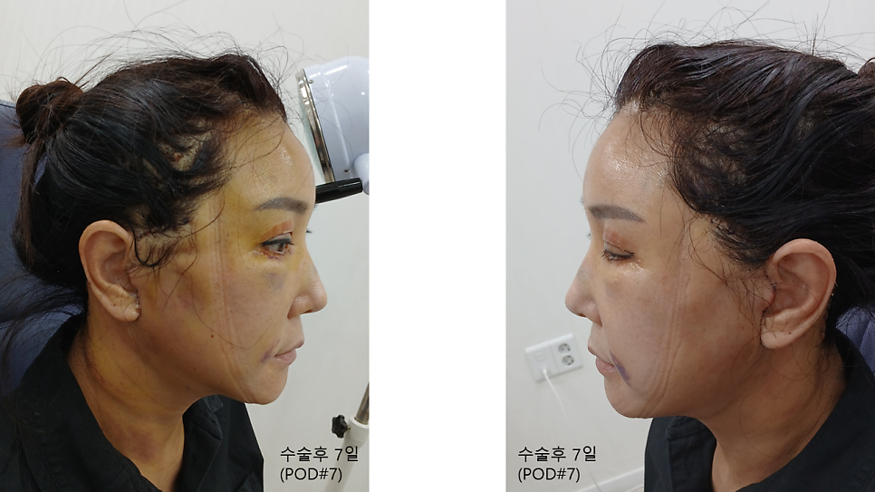 Hyperbaric Oxygen Therapy for Faster Recovery After Plastic Surgery image 5