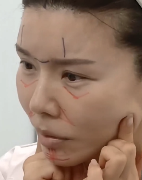 Correcting Cheek Sagging and Sunken Cheeks After Facial Contouring Surgery image 2