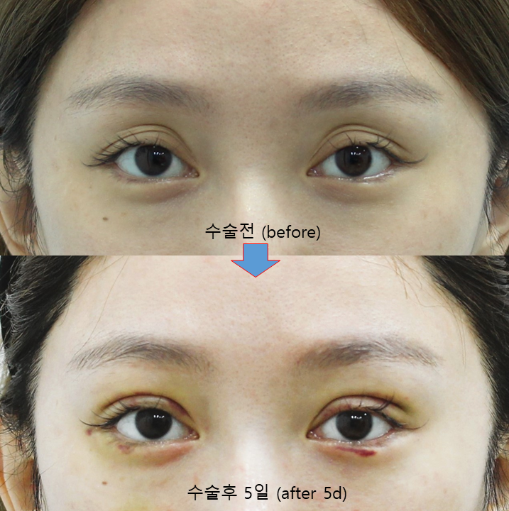 Micro Fat Filters and Micro Cannulas Used for Fat Grafting Around the Eyes image 4