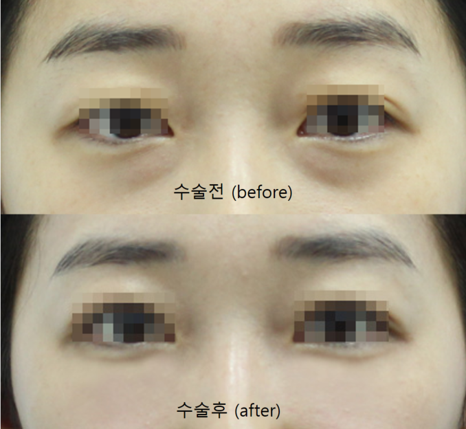 The Surgical Process of Lower Eyelid Fat Repositioning image 6