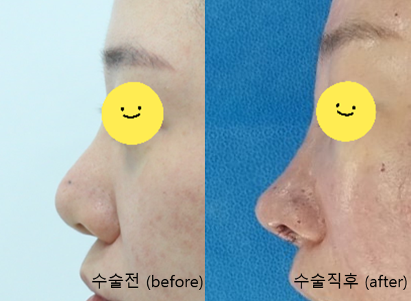 늑연골을 이용한 비주함몰의 교정 관련 이미지 10