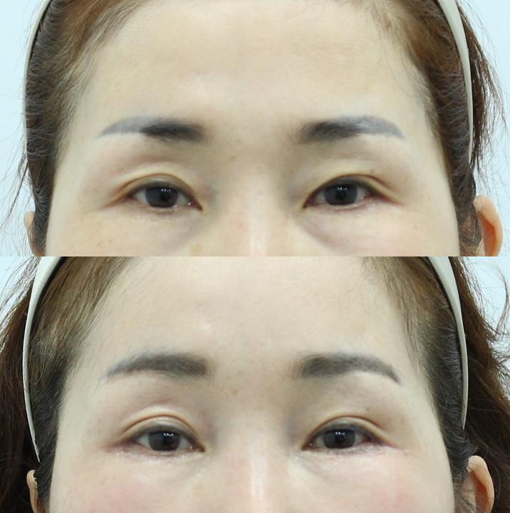 The Effect of Forehead Lift Surgery on the Eyes image 7