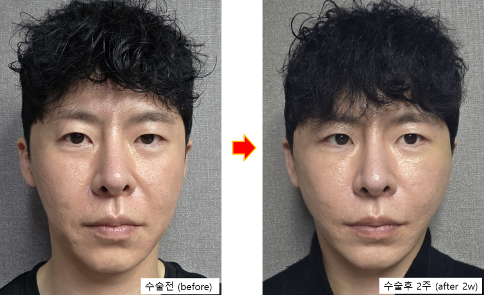 남자 안면거상, 구렛나루를 지키는 것이 중요한 이유 관련 이미지 3
