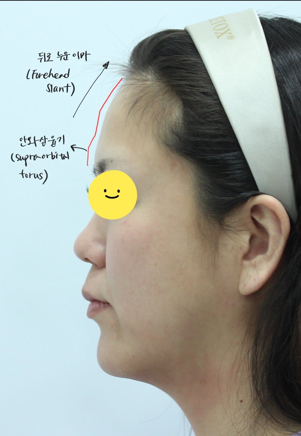 Forehead Fat Grafting for a More Youthful Face image 4