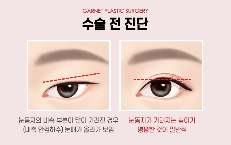 【Garnet Plastic Surgery Director Baek In-soo’s Plastic Surgery Column】 Eye Correction for a Rounder, Kinder Eye Shape image 5