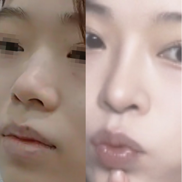 How to Naturally Enhance a Small Nose in Your First Nose Surgery image 6
