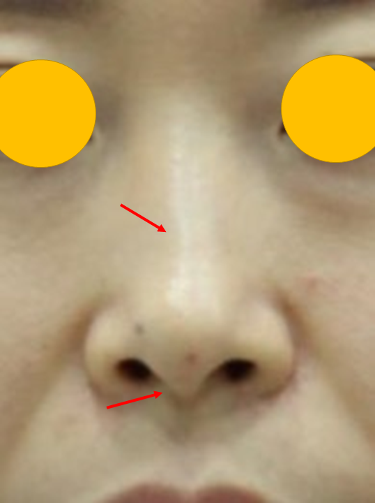 무보형물 코성형, 휜코까지 교정할 수 있을까? 관련 이미지 1