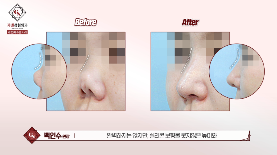 Why You Should Have Revision Rhinoplasty at a Place That Specializes in Apgujeong Nose Revision Surgery (ft. Dr. Baek In-soo) image 10