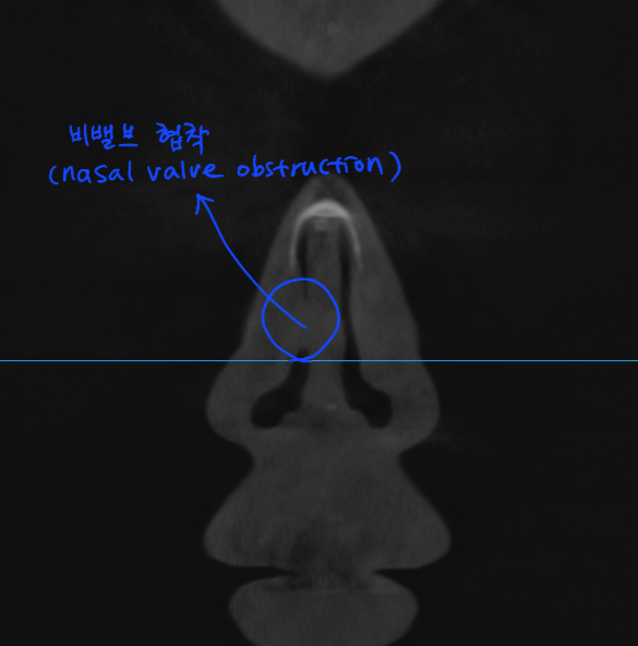 Information You Can Obtain Through CT Scanning During a Consultation for Revision Rhinoplasty image 5
