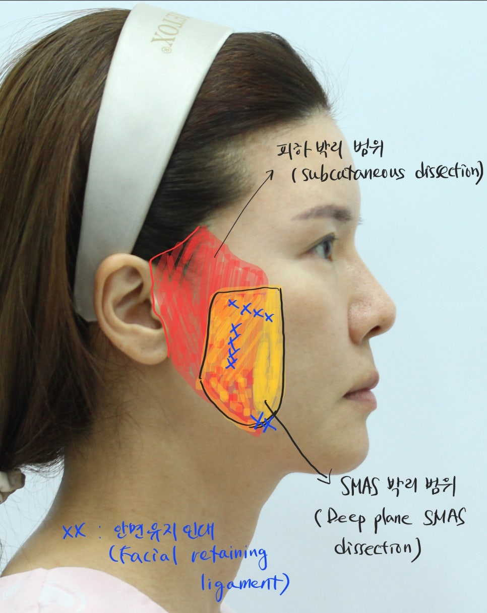Correcting Cheek Sagging and Sunken Cheeks After Facial Contouring Surgery image 4