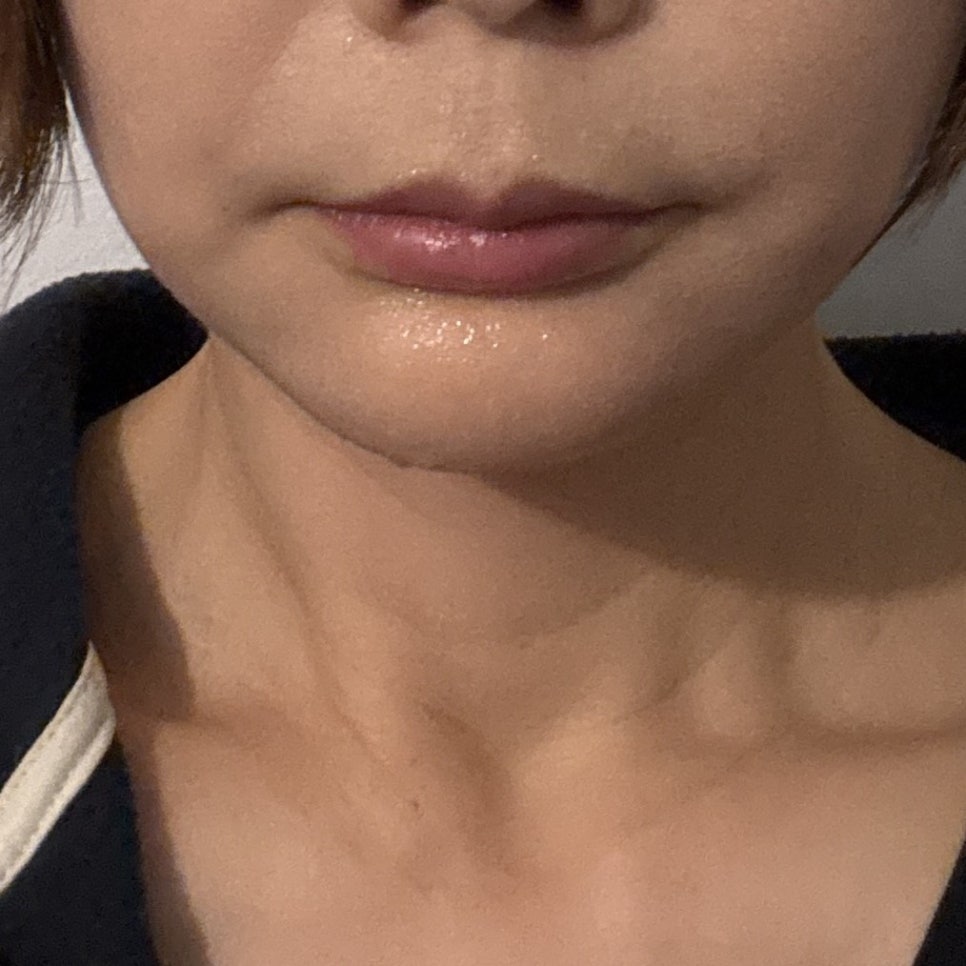 입가 주름 리프팅, 마리오네트 라인 개선하는 방법 관련 이미지 6