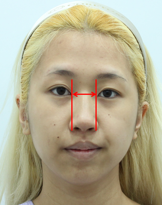첫번째 코성형, 첫코성형, 20대 코성형 관련 이미지 7
