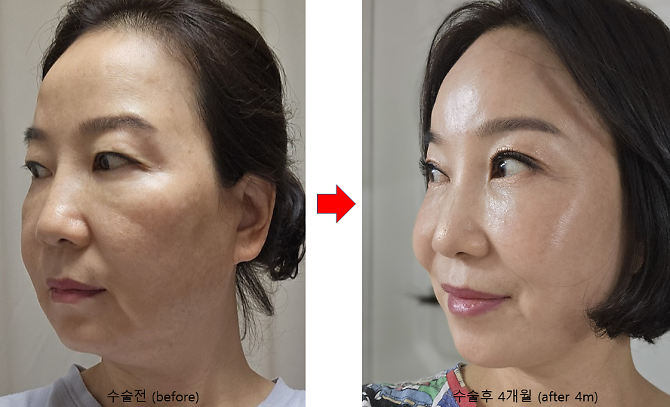 안티에이징 수술의 효과와 유지기간 관련 이미지 5