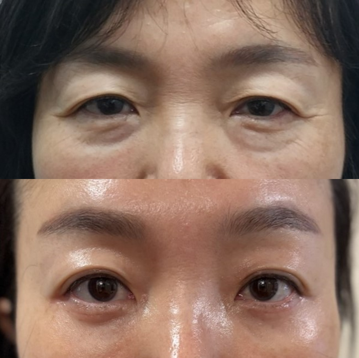 Why Horizontal Nasal Bridge Wrinkles and Eyelid Ptosis Occur Together, and the Role of Brow Lift Surgery image 7