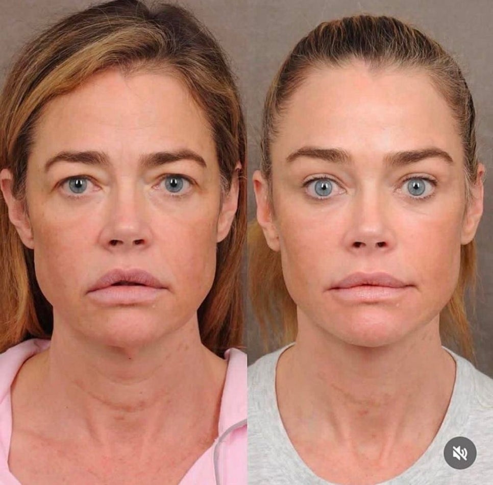 The Result of the $200,000 Anti-Aging Surgery Chosen by a Hollywood Star image 7