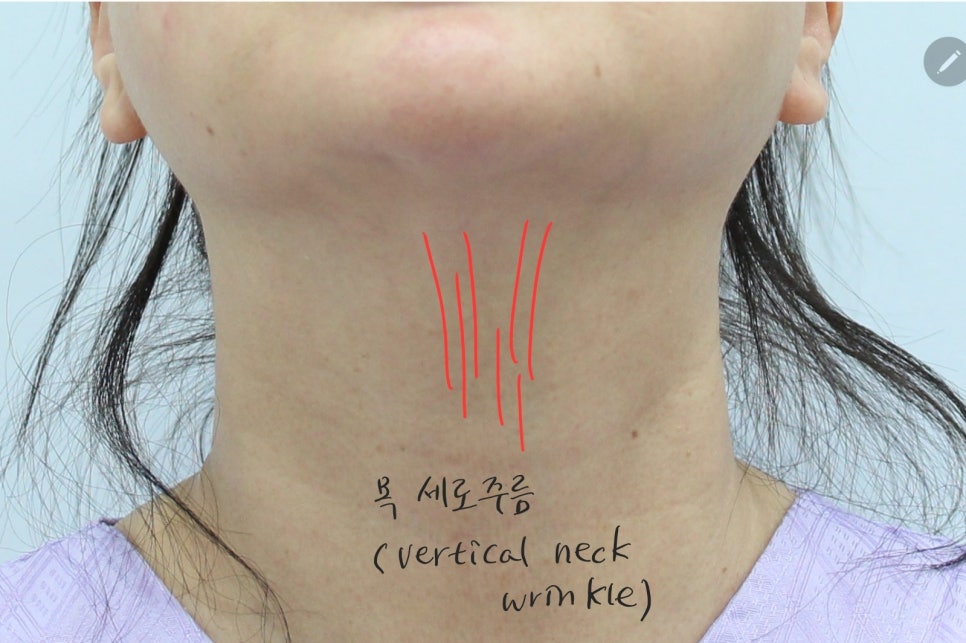 Submental Incision Neck Lift Performed Together with Facelift image 3