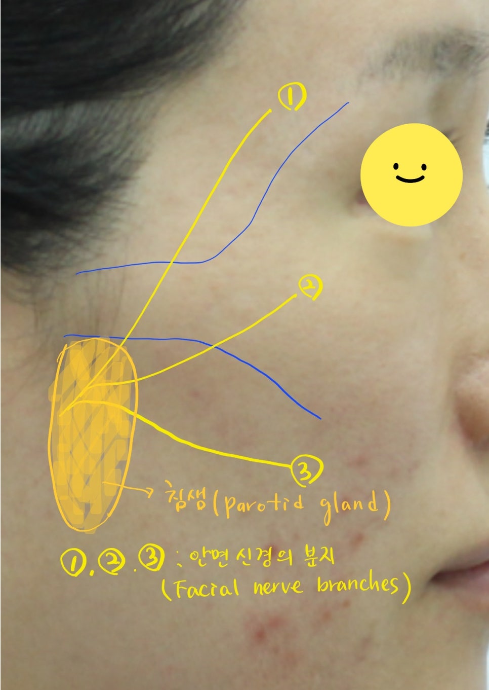 A Specialized Fat Grafting Correction Method for Hollowed Side Cheeks image 6