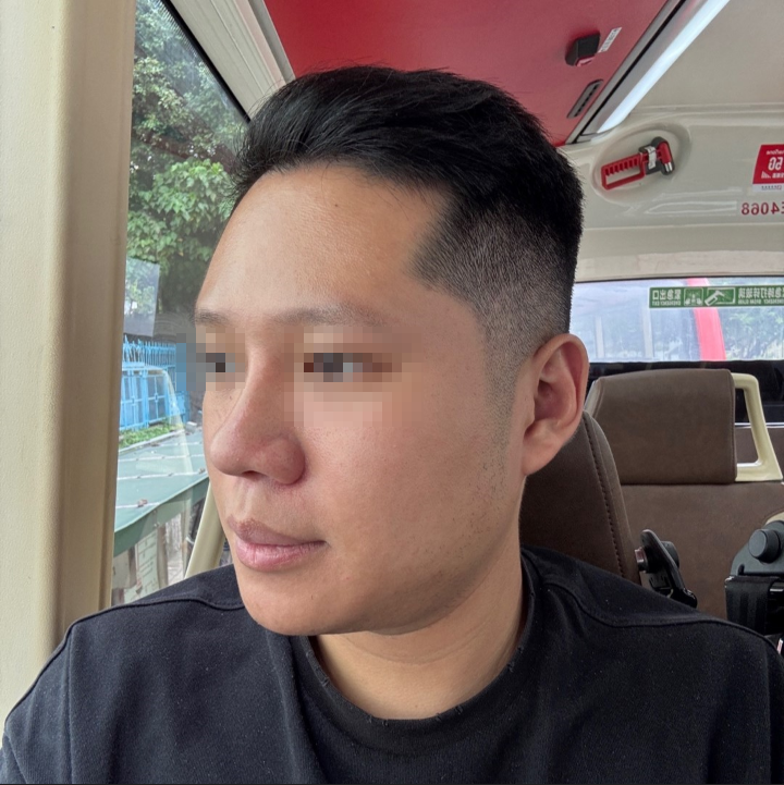 남자 복코 성형, 두꺼운 코끝을 자연스럽게 개선하기 관련 이미지 5