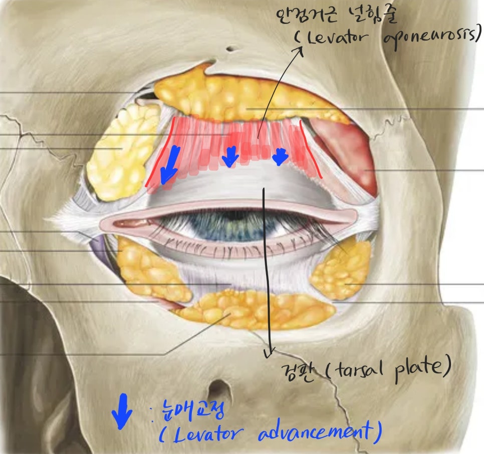 쌍꺼풀 수술과 함께 착한 이미지를 만드는 눈매교정 관련 이미지 4