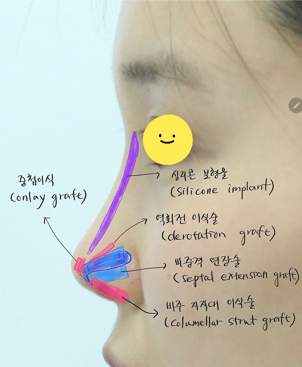 Precautions When Using Ear Cartilage in Rhinoplasty image 4