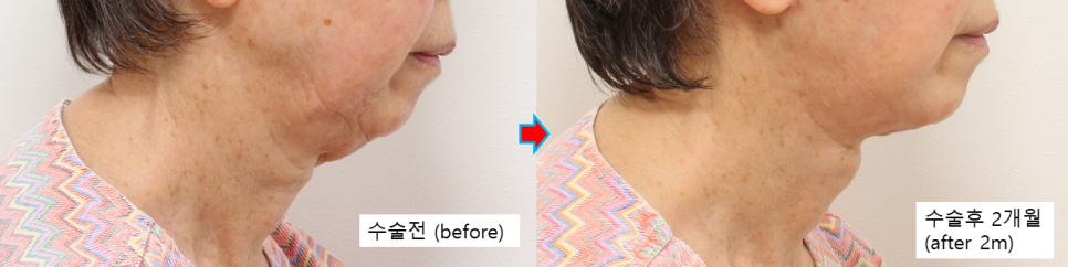 심한 목처짐 개선, 목거상의 핵심은 심부 볼륨과 피부 재배치입니다 관련 이미지 5