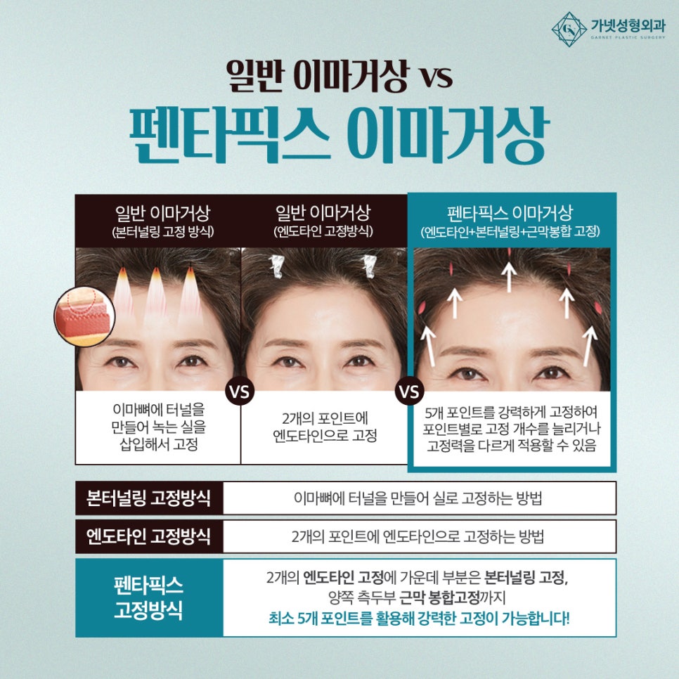 엠마 스톤의 변화, 이마거상일까? 관련 이미지 4