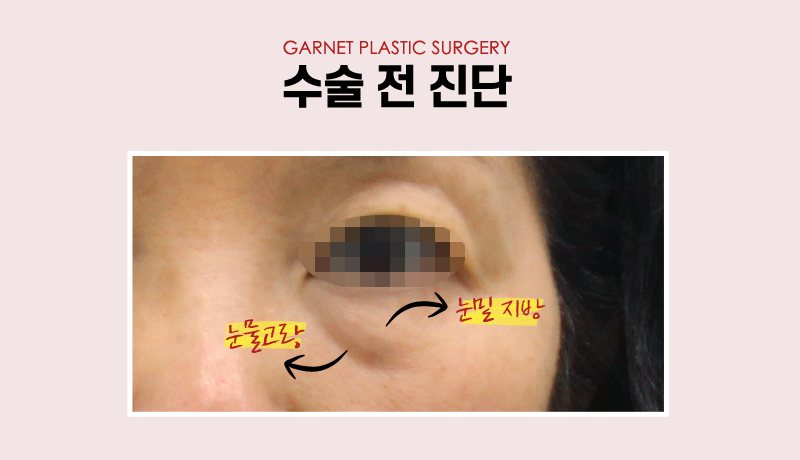 압구정역성형외과에서 알아보는 대표적인 동안성형 종류! 관련 이미지 5