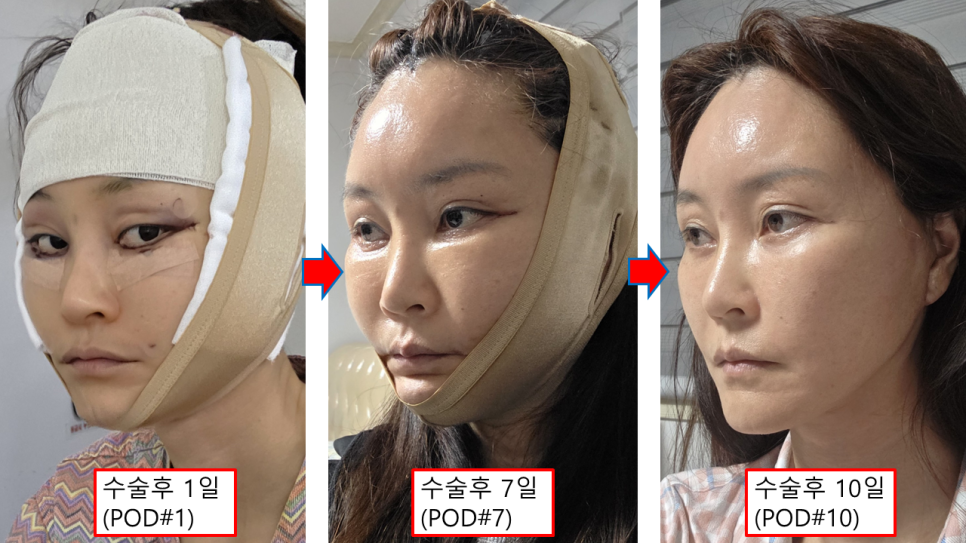 안티에이징 수술 후 회복과정 안내 관련 이미지 2