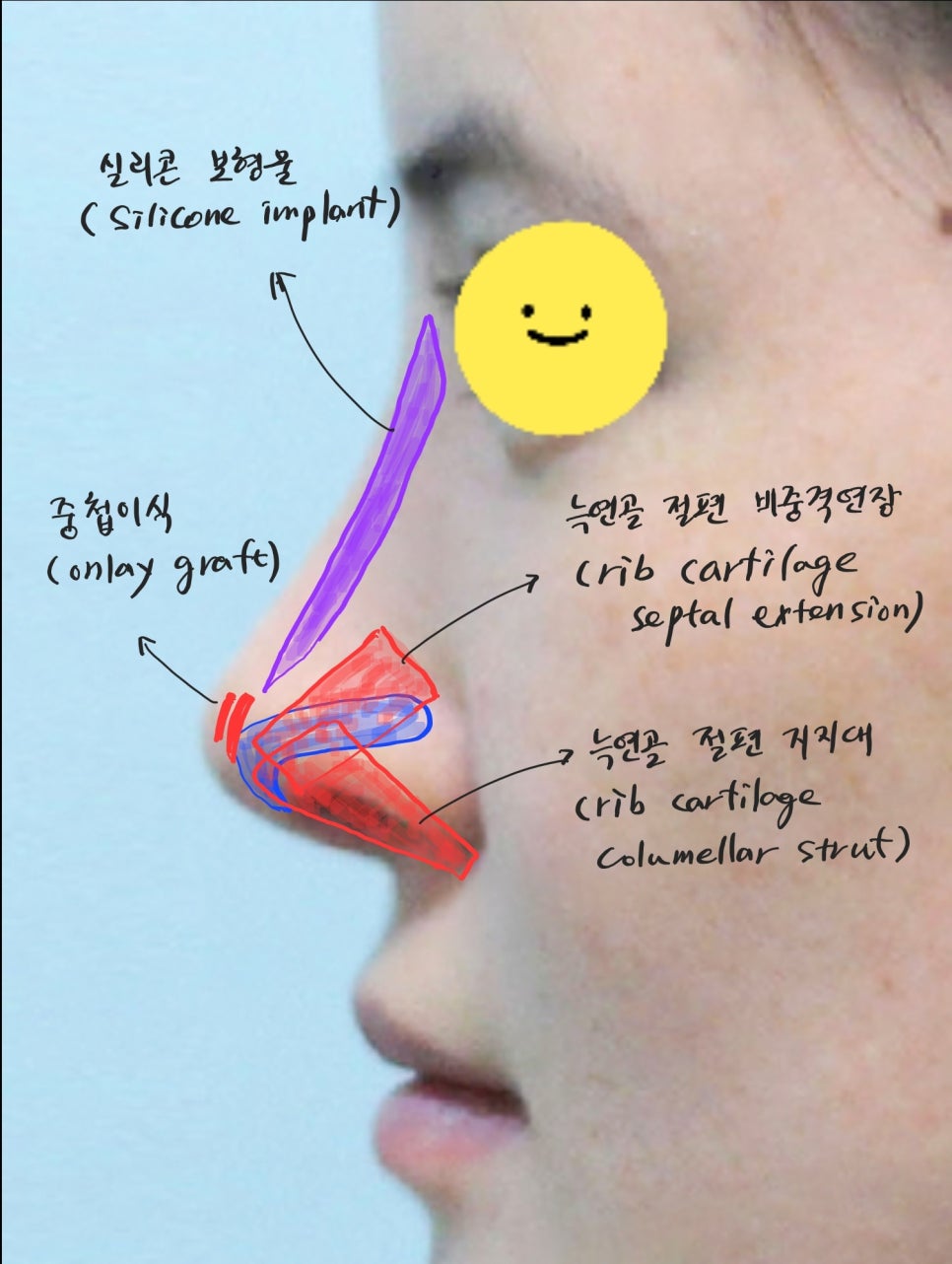 코성형을 통한 중안면부 함몰의 개선 관련 이미지 4