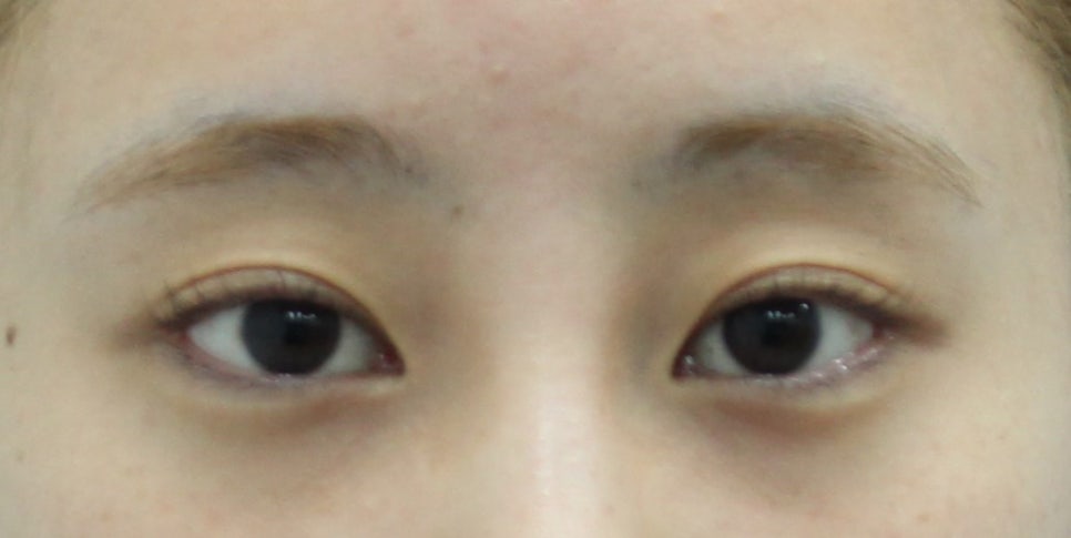 Non-incisional Eye Correction in Revision Surgery for Buried-Method Double Eyelids image 10