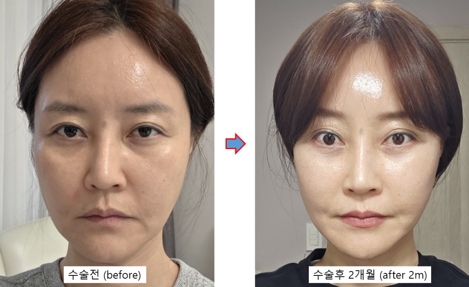 수직 미니거상, 정말 중요한 것은 관련 이미지 3