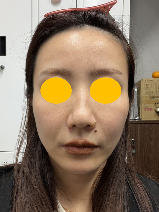 A Deep Mini Facelift Case for a Japanese Patient Who Was Disappointed with the Longevity of Thread Lifting image 1