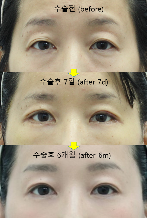 Can People in Their 50s Have Non-Incisional Double Eyelid Surgery? A Natural Look Without Skin Excision image 4