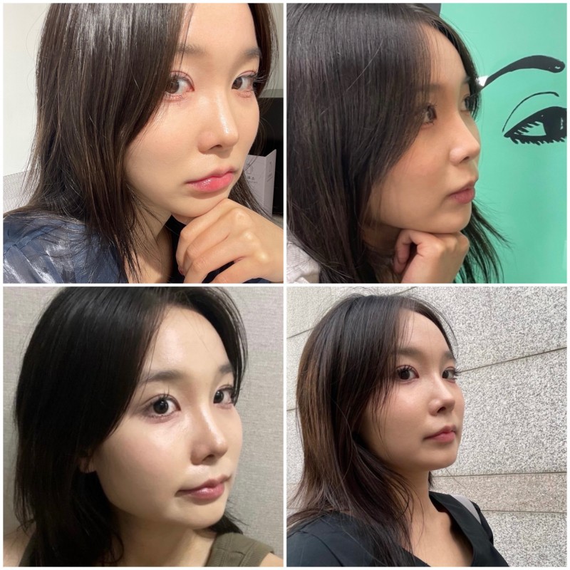 Treatment Process to Speed Recovery After Rhinoplasty image 7