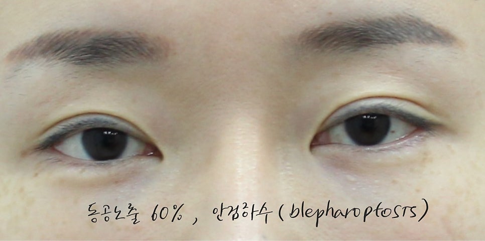 Double Eyelid Surgery and Ptosis Correction image 2
