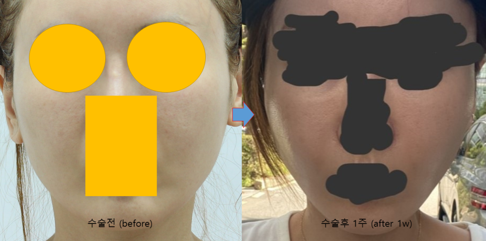Natural Thread Lifting Using the Face’s Glide Planes image 4