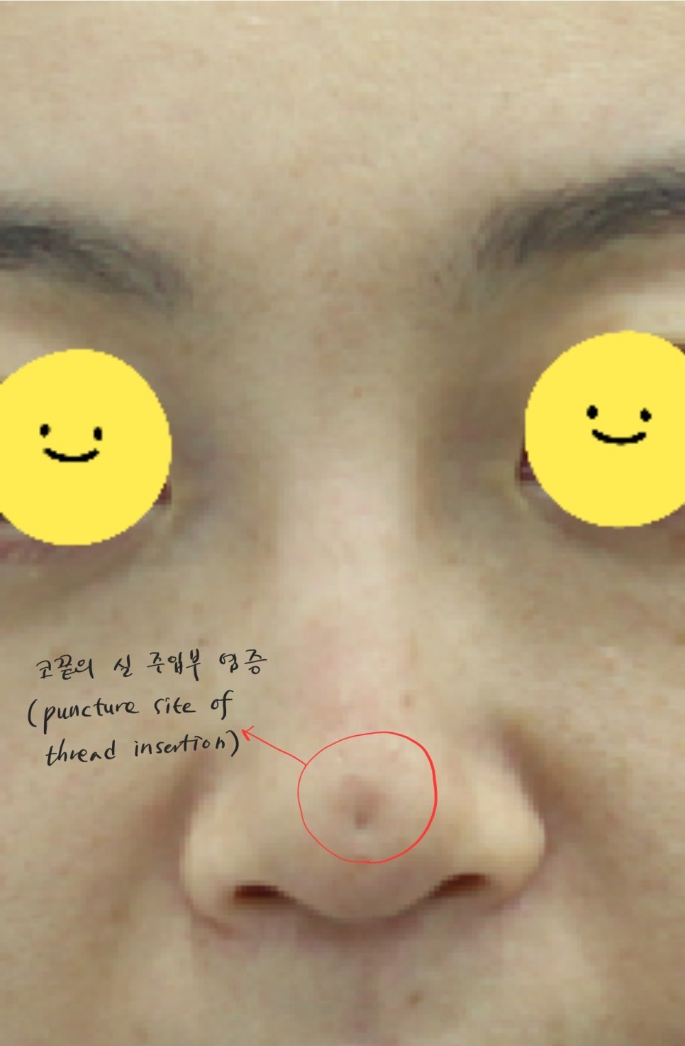 실과 필러로 높힌 코에서 발생한 염증의 치료 관련 이미지 2