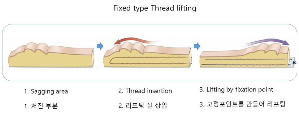 실리프팅, 어떤 실을 어떻게 사용하느냐가 중요한 이유 관련 이미지 3