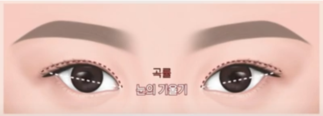 Lateral and Lower Canthoplasty with Under-Eye Fat Repositioning image 6
