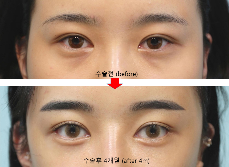 Lateral and Lower Canthoplasty with Under-Eye Fat Repositioning image 9
