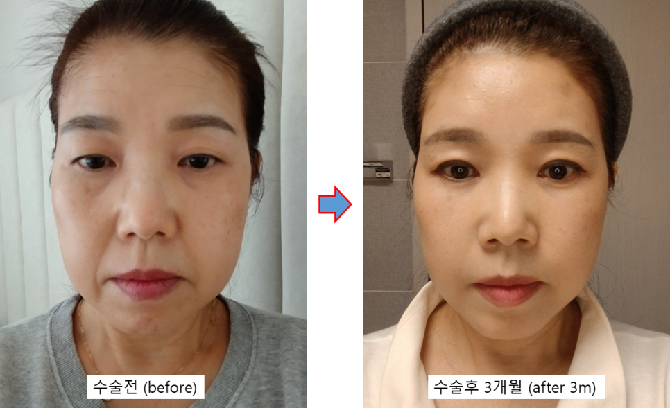 수술만큼 중요한 회복, 결과를 바꾸는 관리의 차이 관련 이미지 7